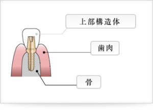 implant_img02