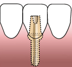 implant_img03