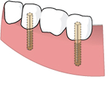 implant_img04