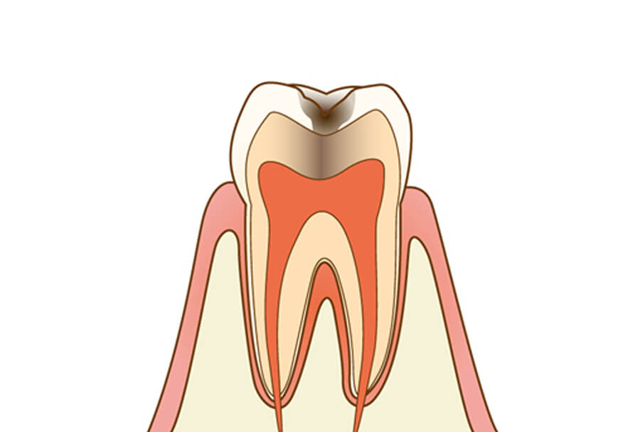 C2：象牙質に達した虫歯
